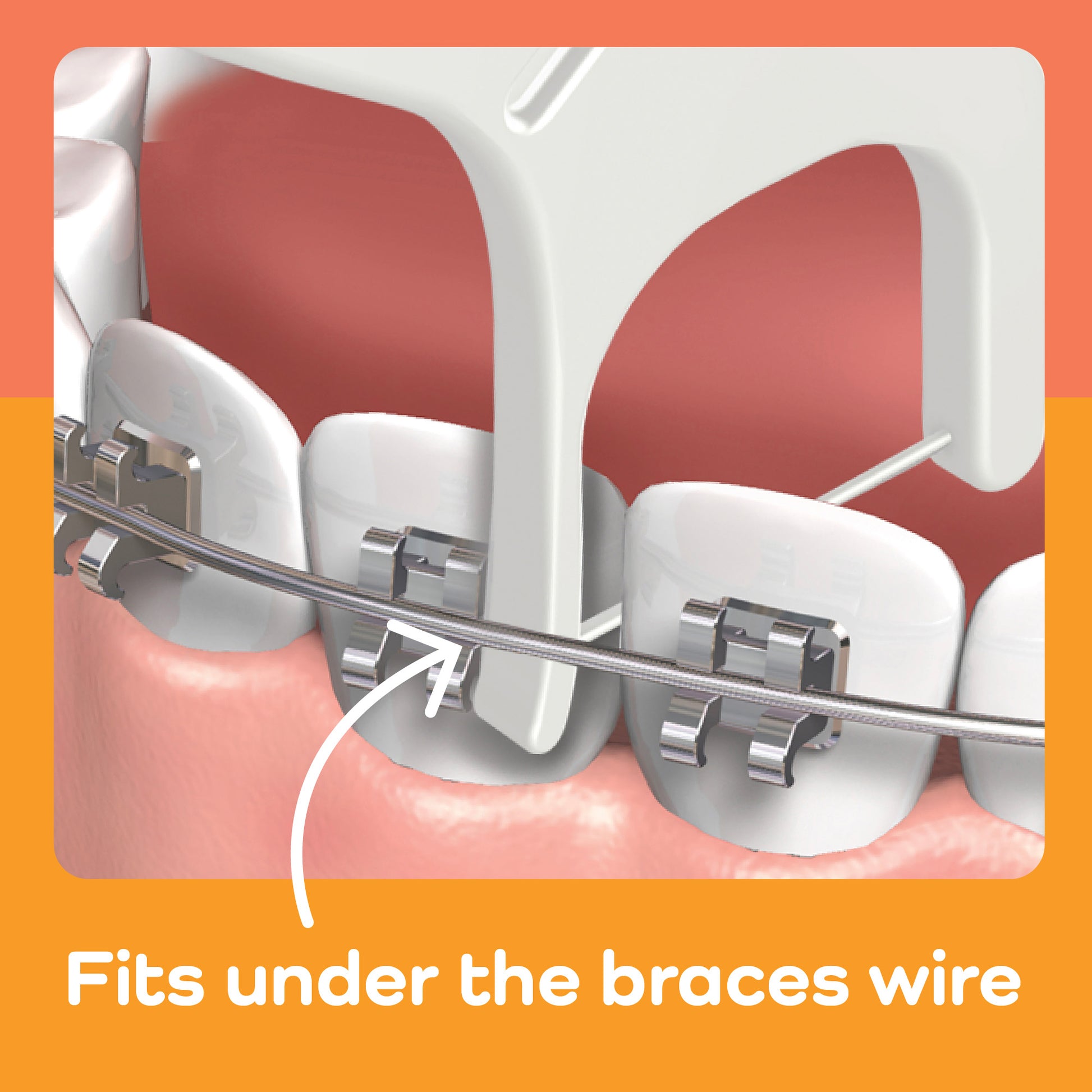 Fits under the braces wire
