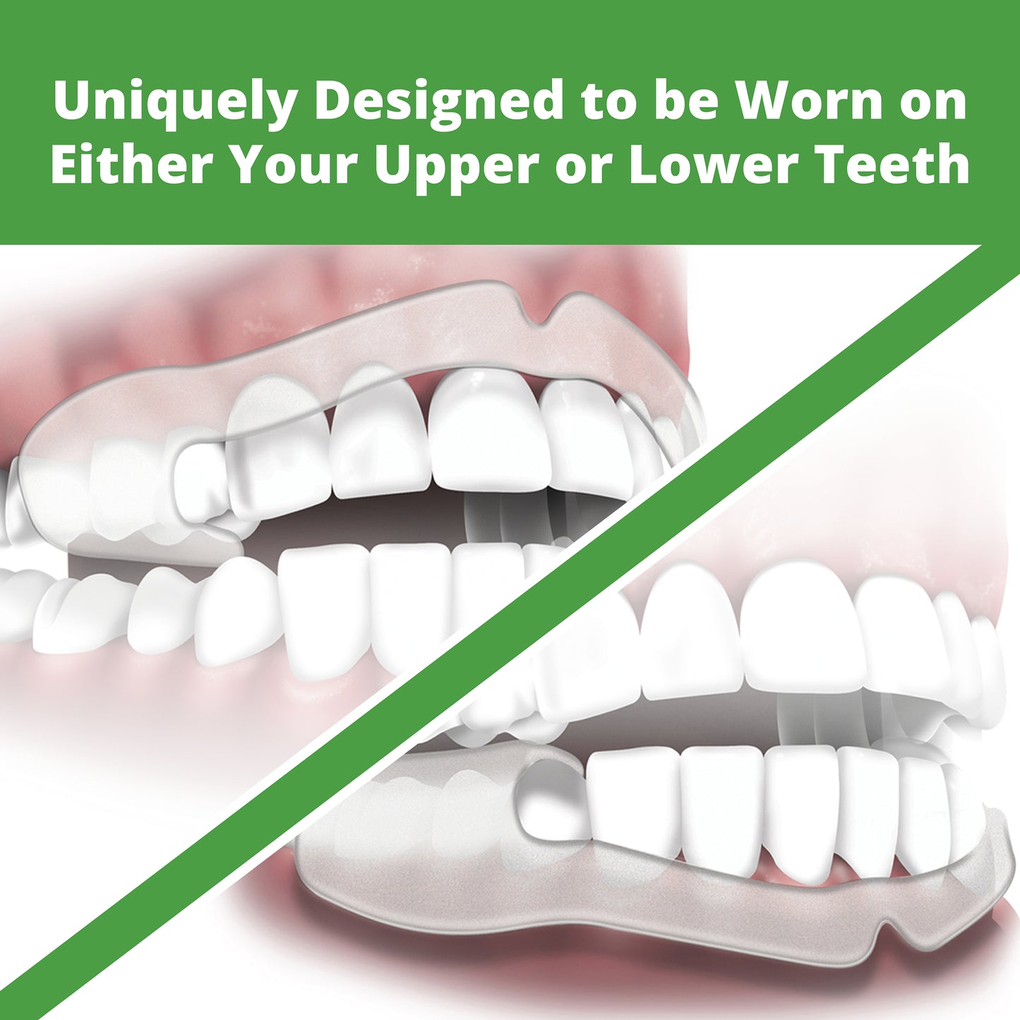 Uniquely Designed to be Worn on Either Your Upper or Lower Teeth. 1 set of upper teeth and 1 set of lower teeth each with Grind No More Night Guards placed on them